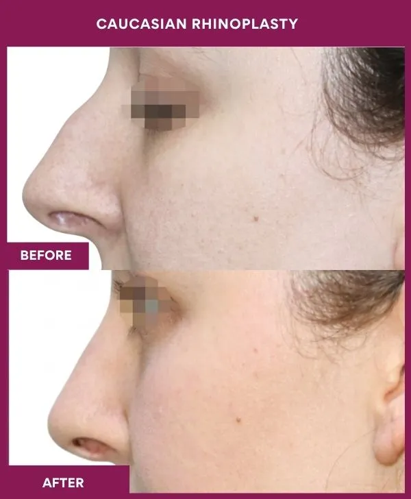 caucasian-rhinoplasty-surgery-before-after-results-mumbai-india-patient01-side-left