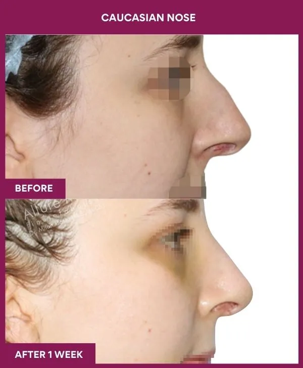 caucasian-rhinoplasty-surgery-before-after-results-mumbai-india-patient01-side-right