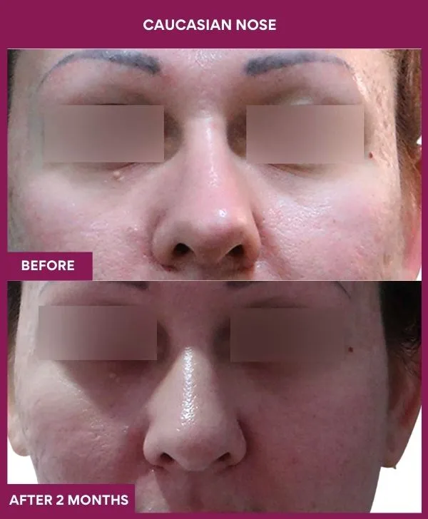 caucasian-rhinoplasty-surgery-before-after-results-mumbai-india-patient02-front