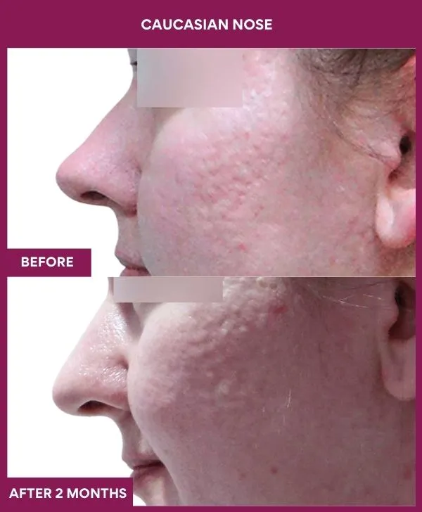 caucasian-rhinoplasty-surgery-before-after-results-mumbai-india-patient02-side-left