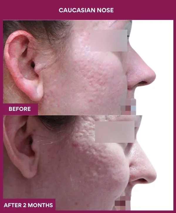caucasian-rhinoplasty-surgery-before-after-results-mumbai-india-patient02-side-right