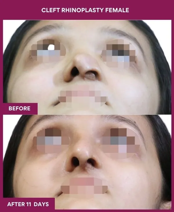 cleft-rhinoplasty-female-before-after-results-mumbai-india-patient01-front-up