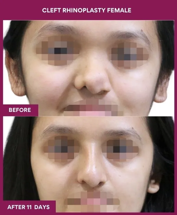cleft-rhinoplasty-female-before-after-results-mumbai-india-patient01-front