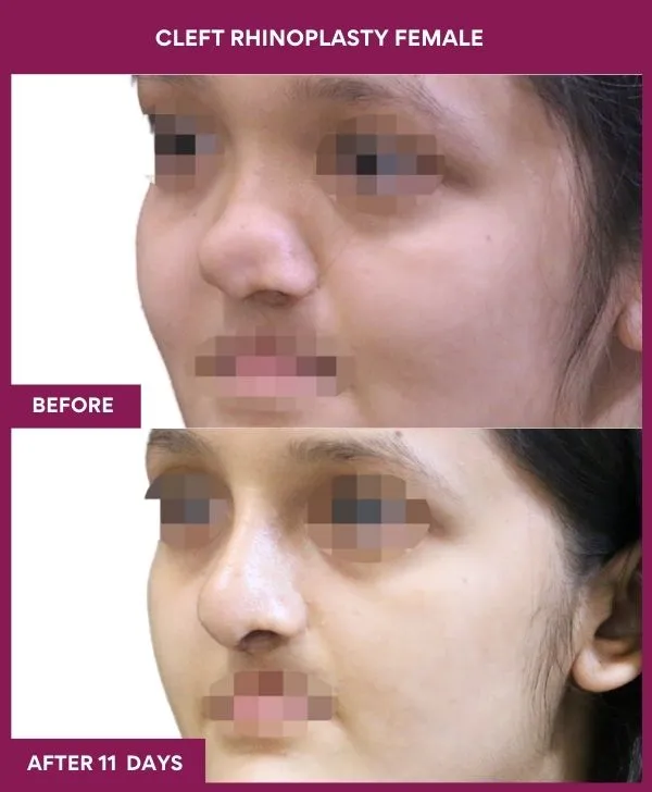 cleft-rhinoplasty-female-before-after-results-mumbai-india-patient01-side-left