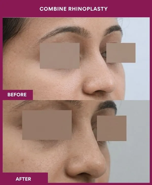 combined-rhinoplasty-before-after-results-mumbai-patient01-front-right