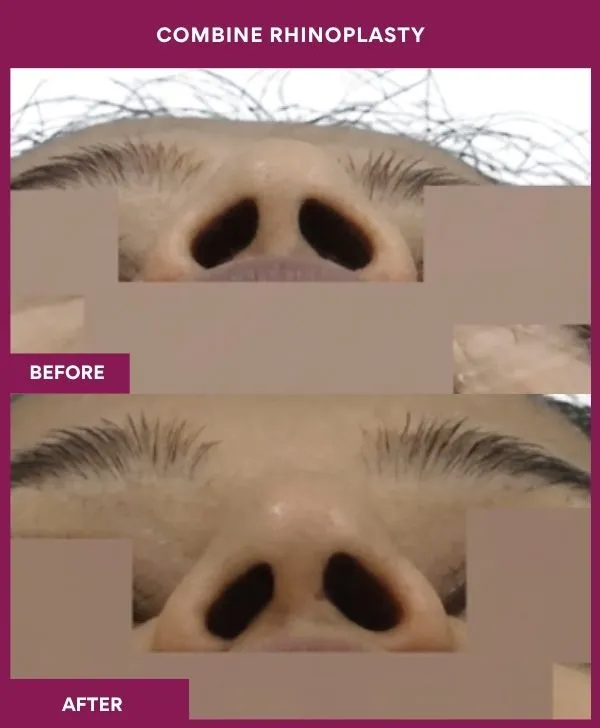 combined-rhinoplasty-before-after-results-mumbai-patient01-front-up