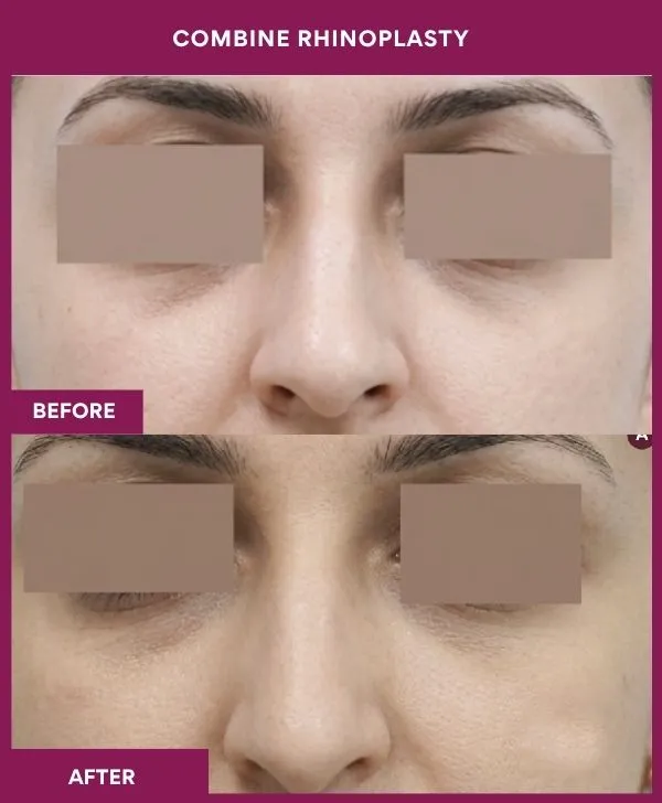 combined-rhinoplasty-before-after-results-mumbai-patient01-front