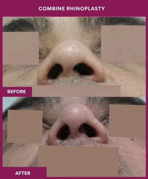combined-rhinoplasty-before-after-results-mumbai-patient02-front-up