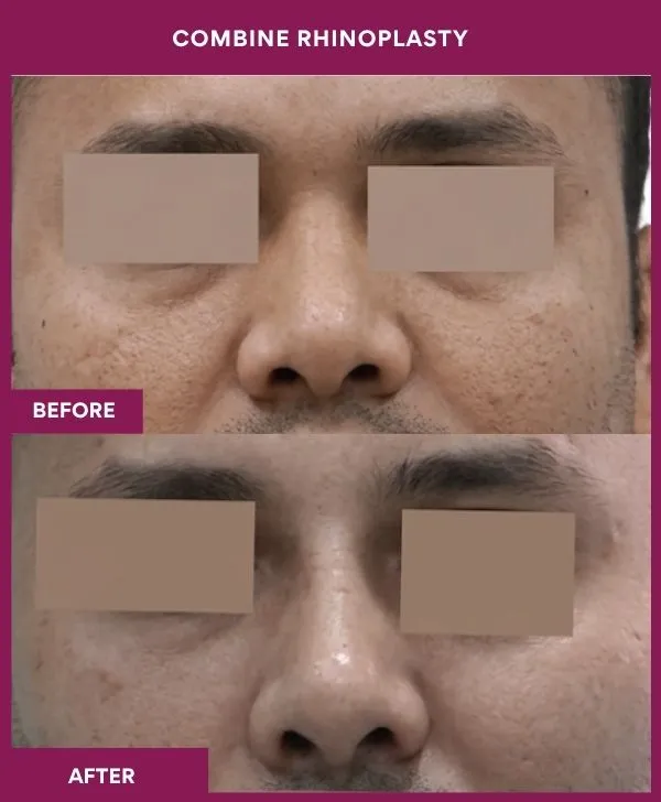 combined-rhinoplasty-before-after-results-mumbai-patient02-front