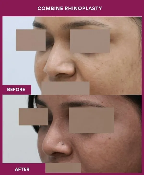 combined-rhinoplasty-before-after-results-mumbai-patient03-front-left