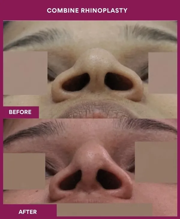 combined-rhinoplasty-before-after-results-mumbai-patient03-front-up