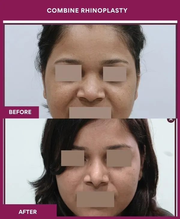 combined-rhinoplasty-before-after-results-mumbai-patient03-front