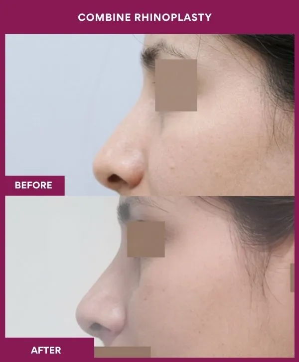 combined-rhinoplasty-before-after-results-mumbai-patient04-side-left