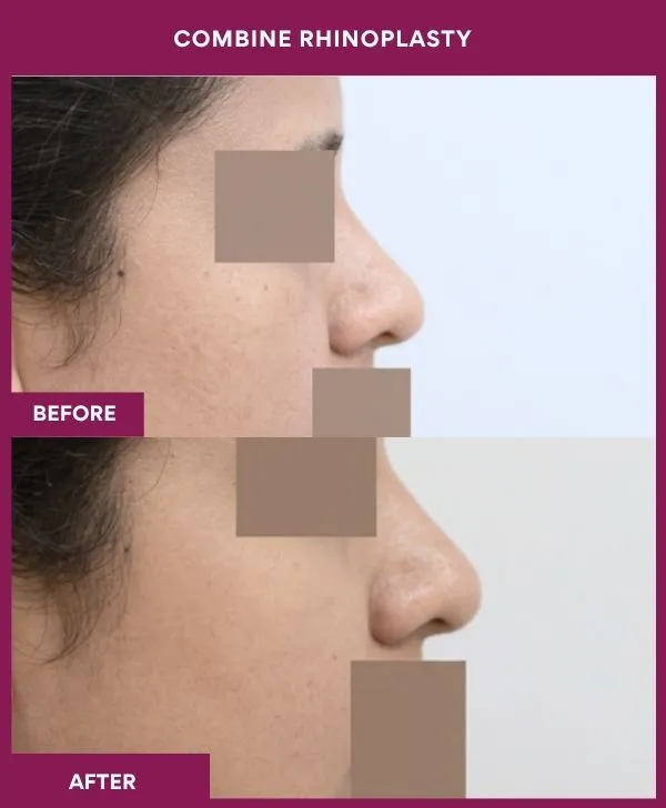combined-rhinoplasty-before-after-results-mumbai-patient04-side-right