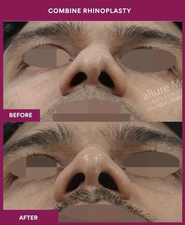 combined-rhinoplasty-before-after-results-mumbai-patient05-front-up