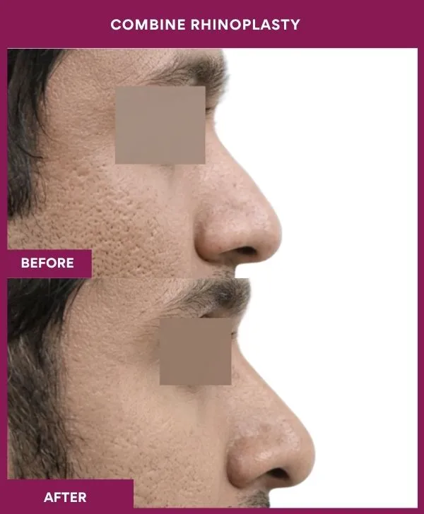 combined-rhinoplasty-before-after-results-mumbai-patient05-side-right