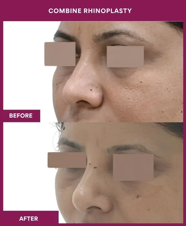 combined-rhinoplasty-before-after-results-mumbai-patient06-front-left