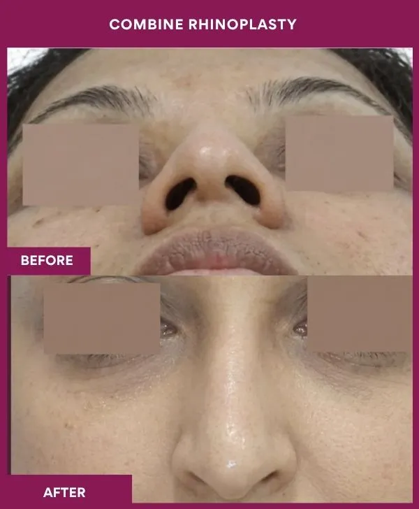 combined-rhinoplasty-before-after-results-mumbai-patient06-front-up