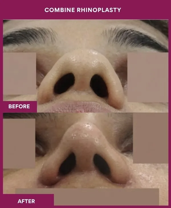 combined-rhinoplasty-before-after-results-mumbai-patient07-front-up