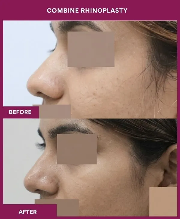 combined-rhinoplasty-before-after-results-mumbai-patient07-side-left