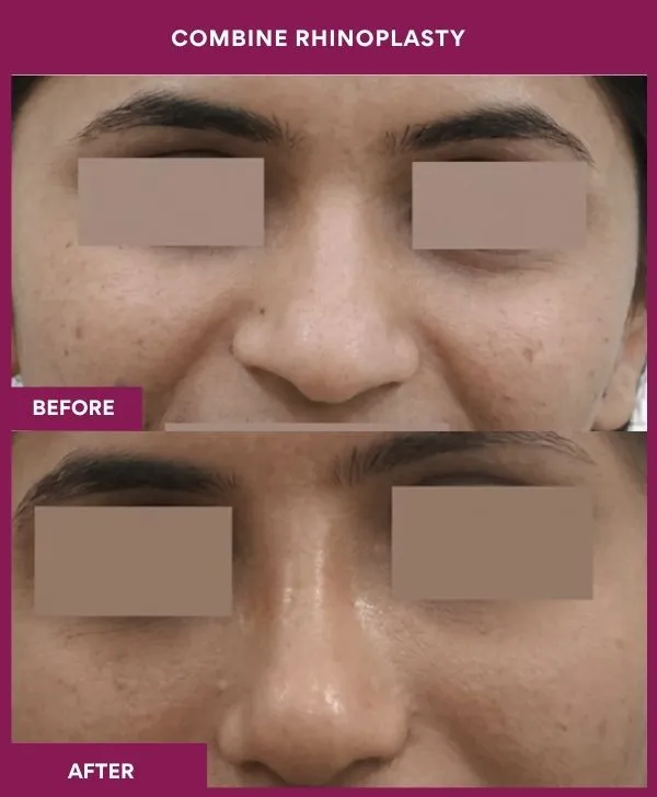 combined-rhinoplasty-before-after-results-mumbai-patient08-front