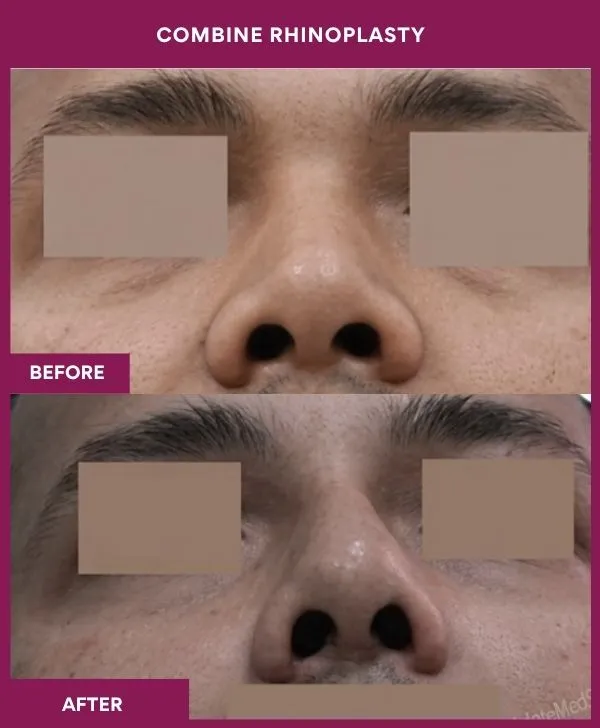 combined-rhinoplasty-before-after-results-mumbai-patient09-front-up