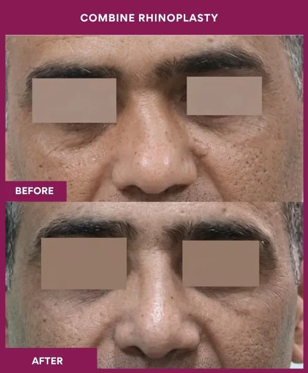 combined-rhinoplasty-before-after-results-mumbai-patient10-front