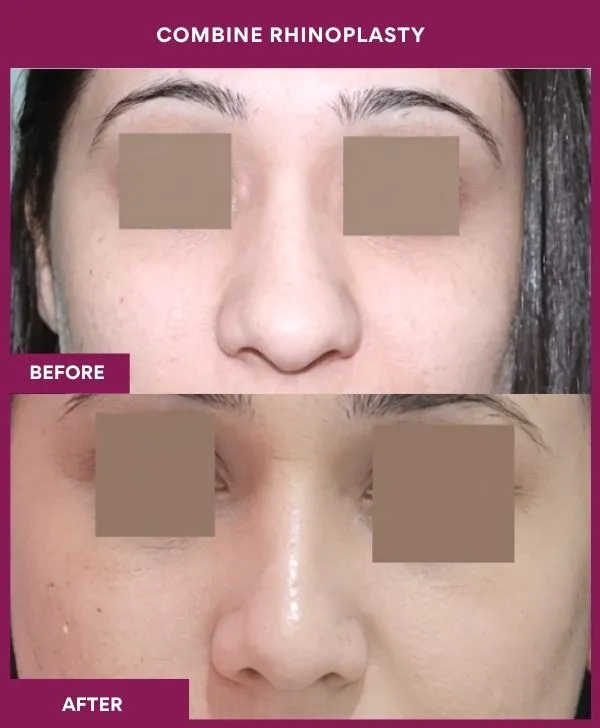 combined-rhinoplasty-before-after-results-mumbai-patient11-front