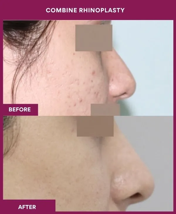 combined-rhinoplasty-before-after-results-mumbai-patient11-side-right