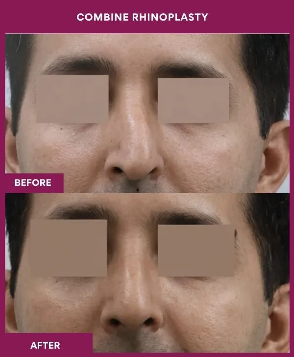 combined-rhinoplasty-before-after-results-mumbai-patient12-front