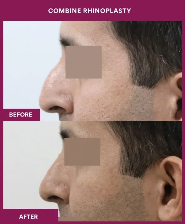 combined-rhinoplasty-before-after-results-mumbai-patient12-side-left