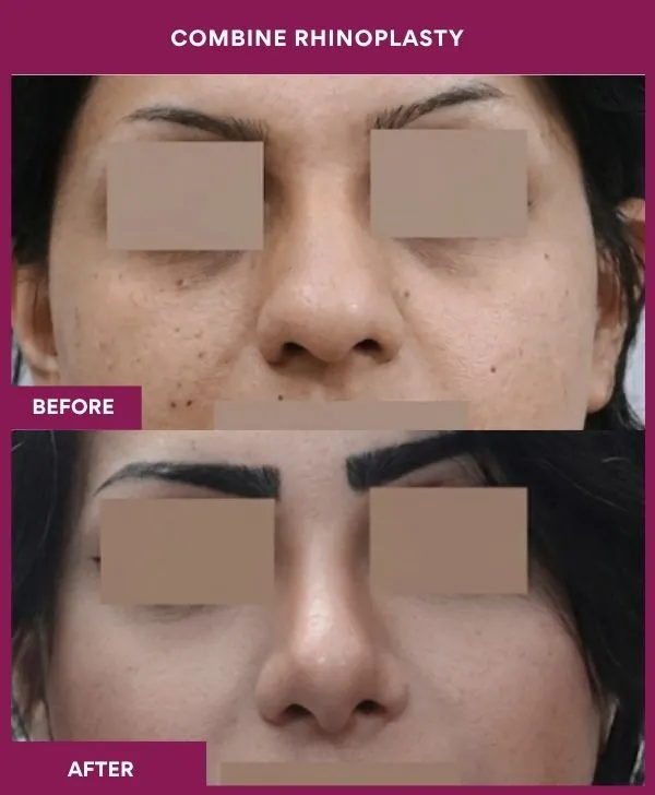 combined-rhinoplasty-before-after-results-mumbai-patient13-front