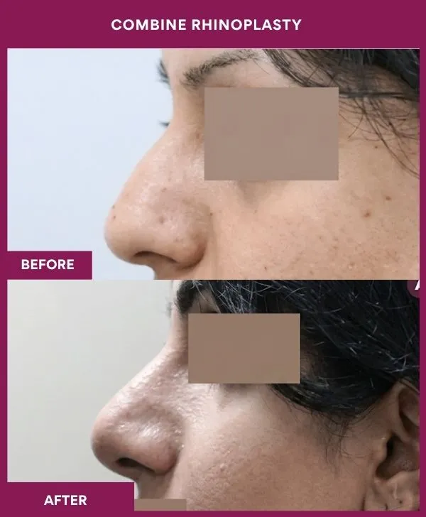 combined-rhinoplasty-before-after-results-mumbai-patient13-side-left