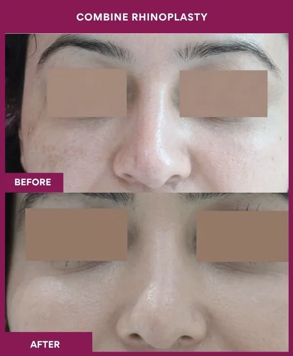 combined-rhinoplasty-before-after-results-mumbai-patient14-front