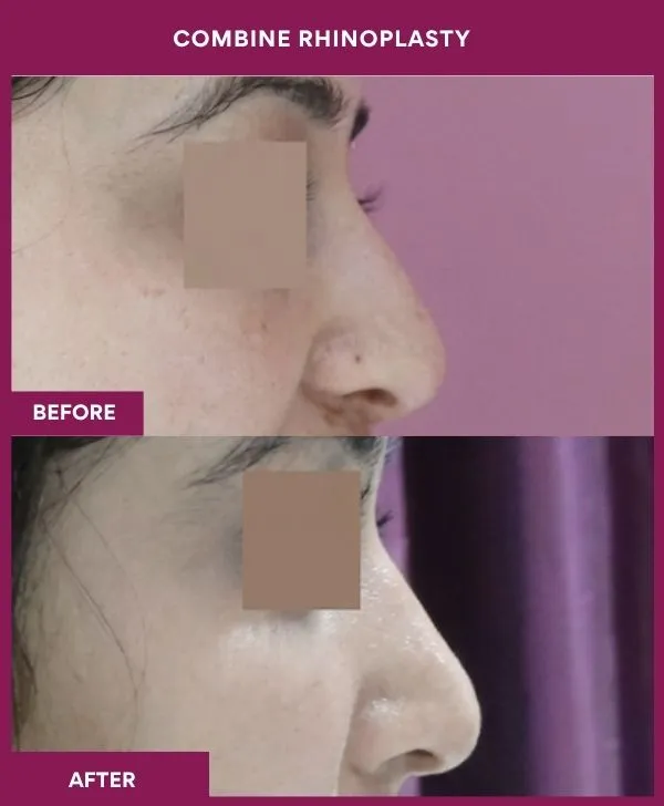 combined-rhinoplasty-before-after-results-mumbai-patient14-side-right