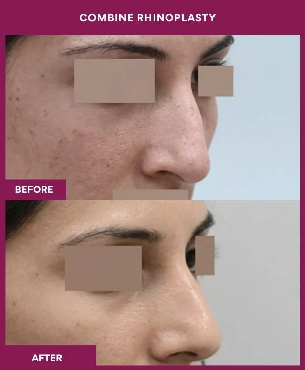 combined-rhinoplasty-before-after-results-mumbai-patient15-side-right