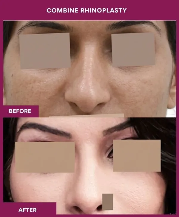 combined-rhinoplasty-before-after-results-mumbai-patient16-side-right