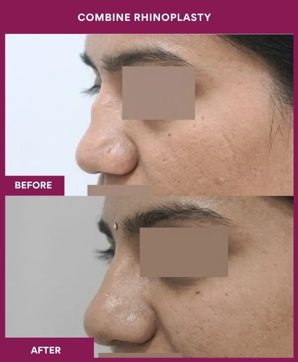 combined-rhinoplasty-before-after-results-mumbai-patient17-side-left