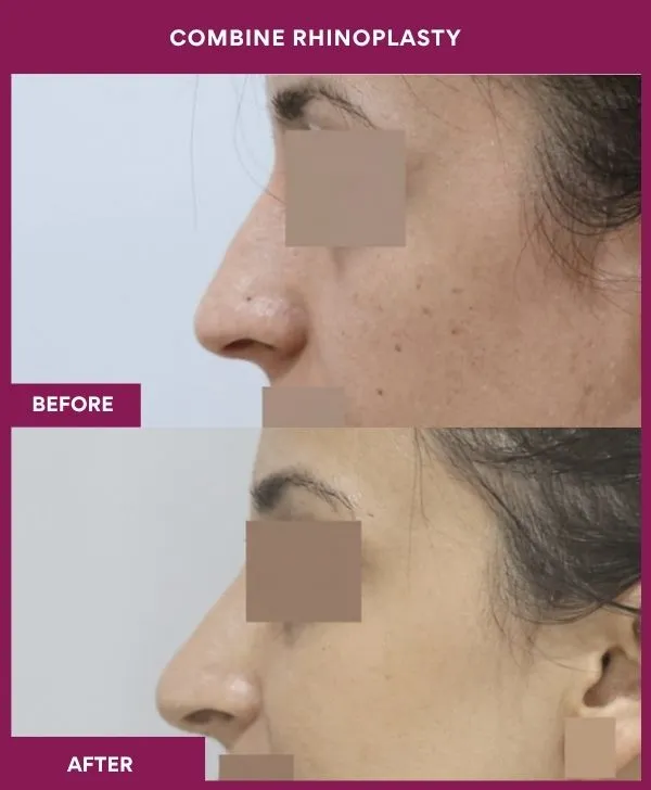combined-rhinoplasty-before-after-results-mumbai-patient18-side-right