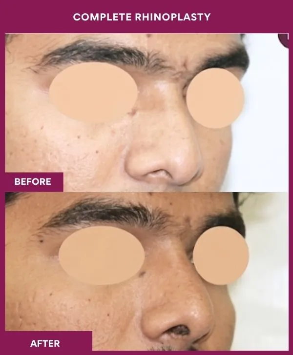 complete-rhinoplasty-surgery-before-after-results-mumbai-india-patient01-front-right