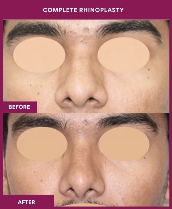 complete-rhinoplasty-surgery-before-after-results-mumbai-india-patient01-front