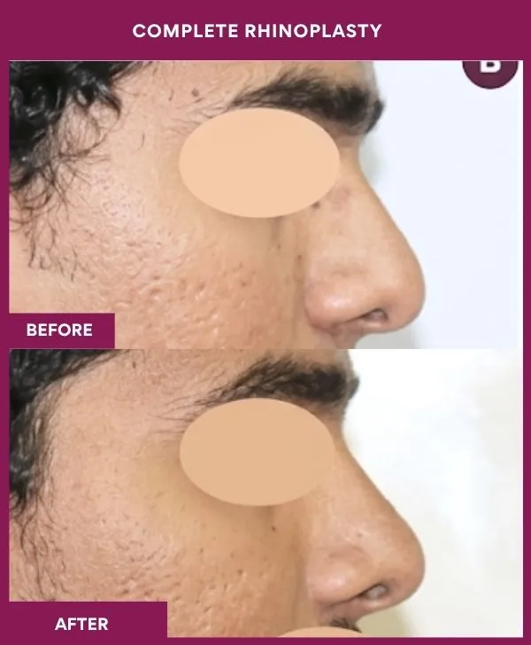 complete-rhinoplasty-surgery-before-after-results-mumbai-india-patient01-side-right