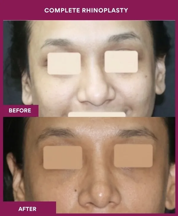 complete-rhinoplasty-surgery-before-after-results-mumbai-india-patient02-front