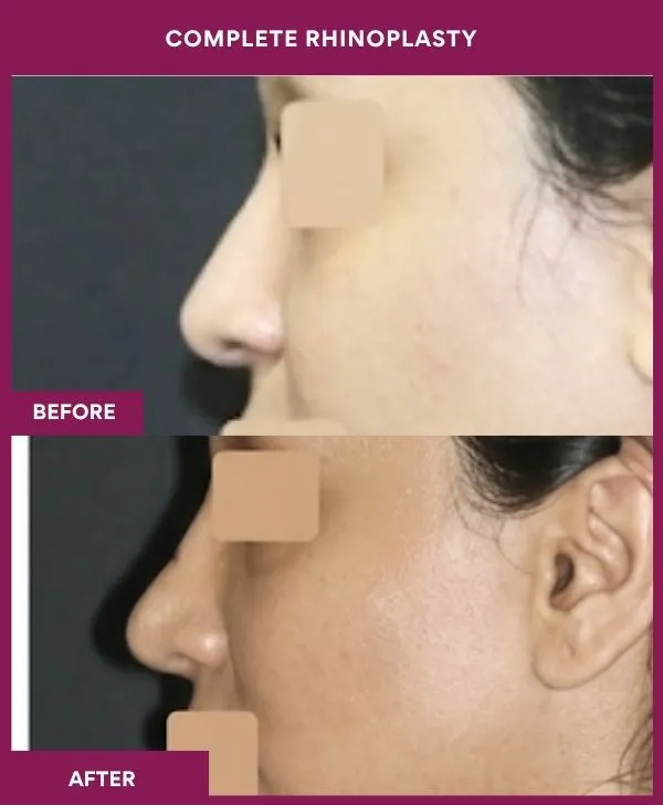 complete-rhinoplasty-surgery-before-after-results-mumbai-india-patient02-side-left