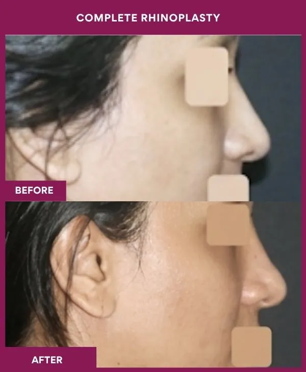 complete-rhinoplasty-surgery-before-after-results-mumbai-india-patient02-side-right