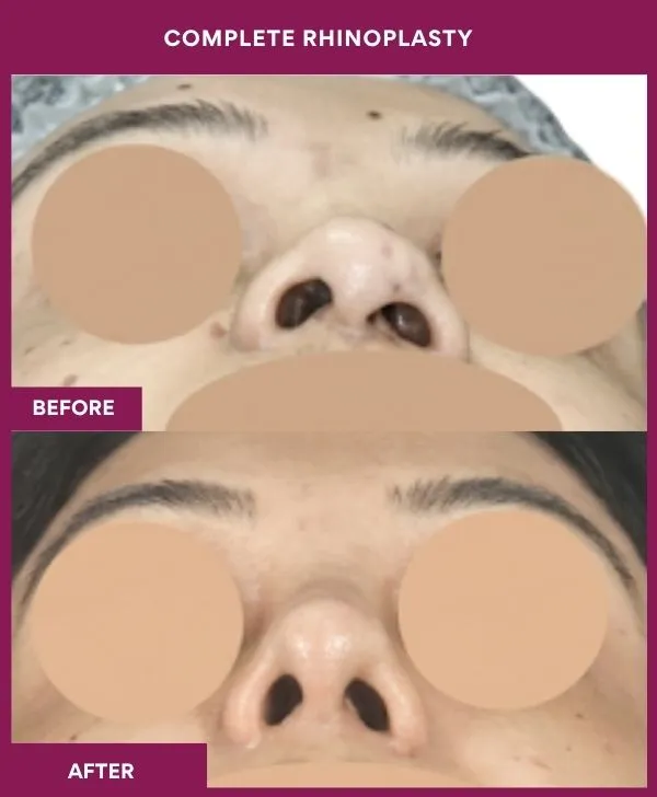 complete-rhinoplasty-surgery-before-after-results-mumbai-india-patient03-front-up
