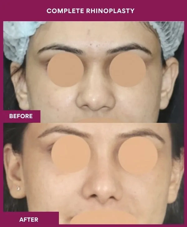 complete-rhinoplasty-surgery-before-after-results-mumbai-india-patient03-front