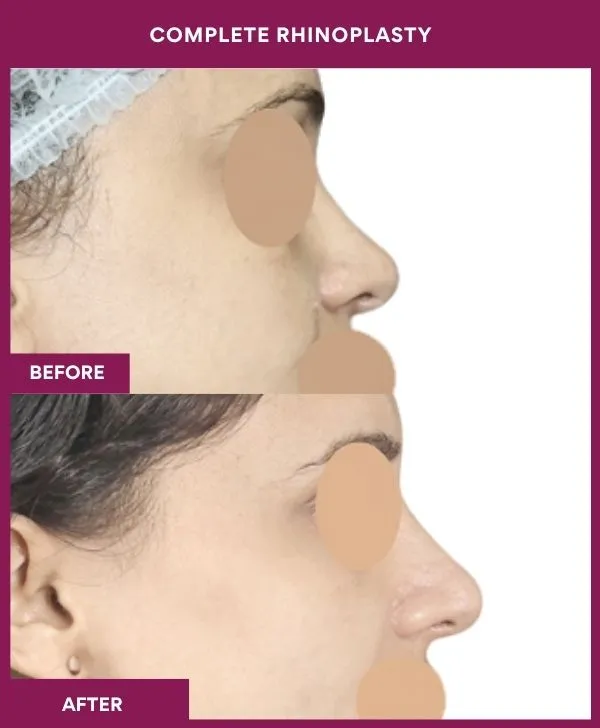 complete-rhinoplasty-surgery-before-after-results-mumbai-india-patient03-side-left