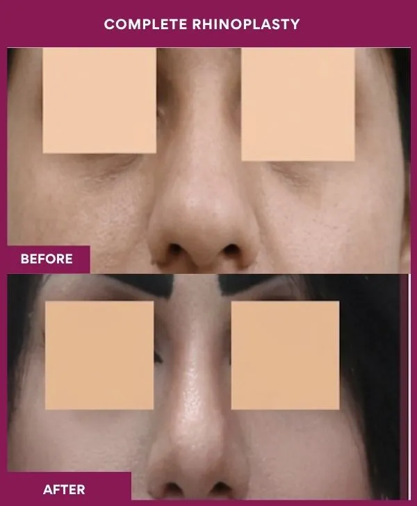 complete-rhinoplasty-surgery-before-after-results-mumbai-india-patient04-front