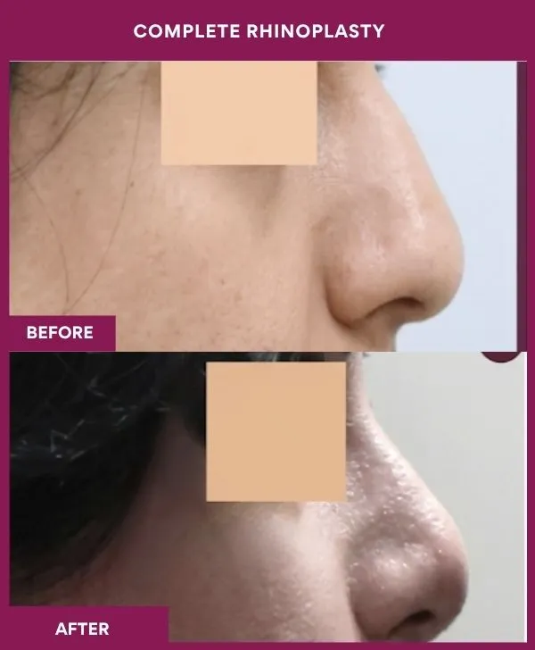 complete-rhinoplasty-surgery-before-after-results-mumbai-india-patient04-side-right